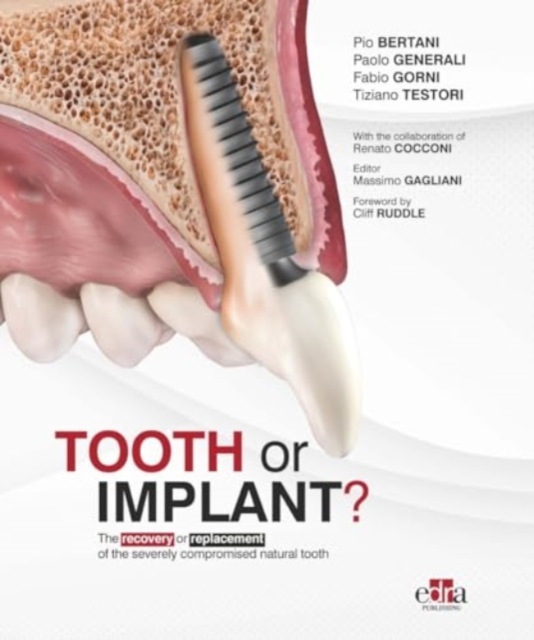 Tooth or Implant, Hardback Book