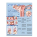 Understanding Ovarian Cancer Anatomical Chart - Book