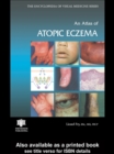 An Atlas of Atopic Eczema - eBook