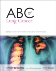 ABC of Lung Cancer - eBook