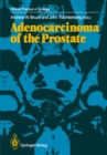 Adenocarcinoma of the Prostate - eBook