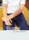 Burns - eBook