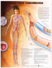 Deep Vein Thrombosis Anatomical Chart - Book
