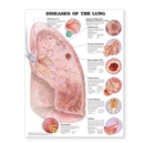 Diseases of the Lung Anatomical Chart - Book