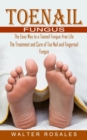 Toenail Fungus : The Easy Way to a Toenail Fungus-free Life (The Treatment and Cure of Toe Nail and Fingernail Fungus) - Book