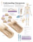 Understanding Osteoporosis Laminated Poster - Book