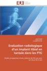 Evaluation Radiologique D Un Implant Tibial En Tantale Dans Les Ptg - Book
