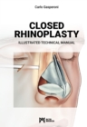 Closed Rhinoplasty : Illustrated Technical Manual - Book