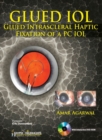 GLUED IOL : Glued Intrascleral Haptic Fixation of a PC IOL - Book