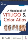 A Handbook of Vitiligo & Color Atlas - Book