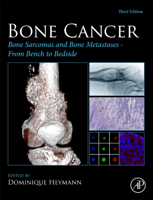 Bone Cancer : Bone Sarcomas and Bone Metastases From Bench to Bedside, Hardback Book