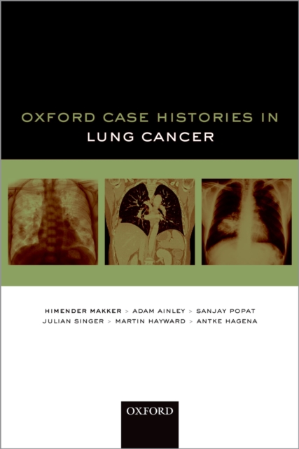 Oxford Case Histories in Lung Cancer, PDF eBook