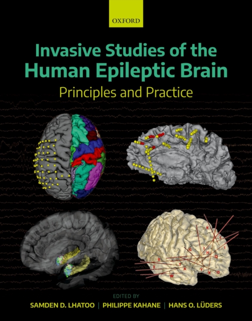 Invasive Studies of the Human Epileptic Brain : Principles and Practice, EPUB eBook