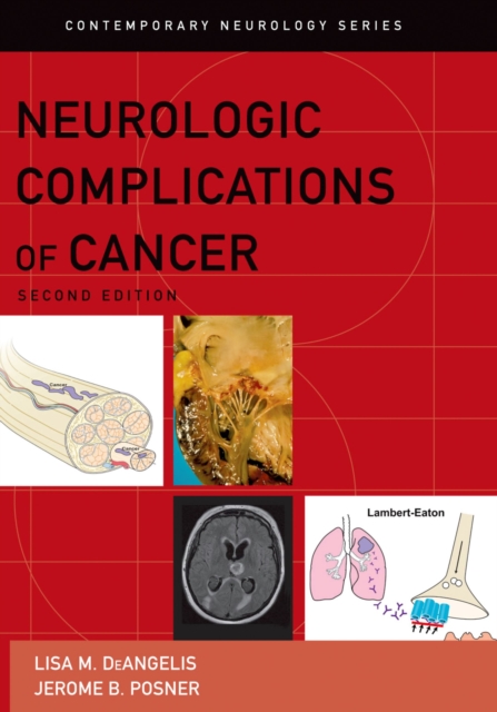 Neurologic Complications of Cancer, PDF eBook