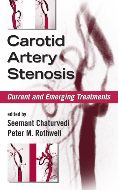 Carotid Artery Stenosis : Current and Emerging Treatments, PDF eBook