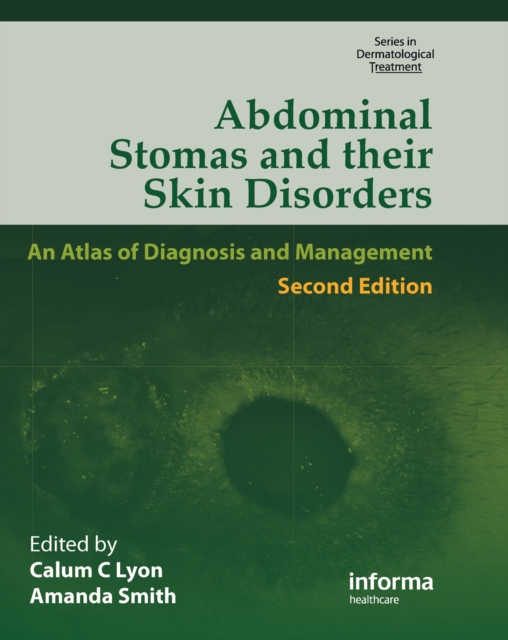 Abdominal Stomas and Their Skin Disorders, PDF eBook