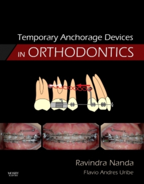 Temporary Anchorage Devices in Orthodontics, Hardback Book