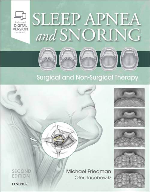 Sleep Apnea and Snoring : Surgical and Non-Surgical Therapy, Hardback Book