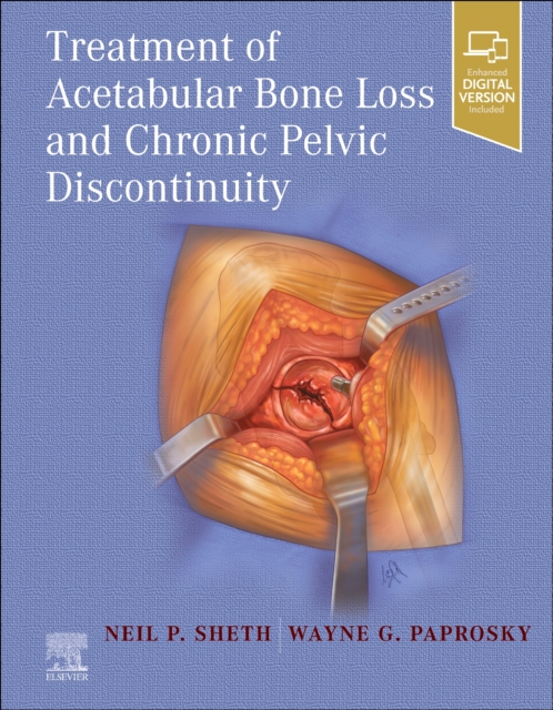 Treatment of Acetabular Bone Loss and Chronic Pelvic Discontinuity, Hardback Book