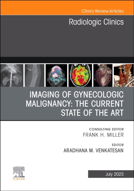 Imaging of Gynecologic Malignancy: The Current State of the Art, An Issue of Radiologic Clinics of North America : Volume 61-4, Hardback Book