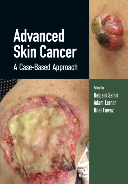 Advanced Skin Cancer : A Case-Based Approach, Hardback Book