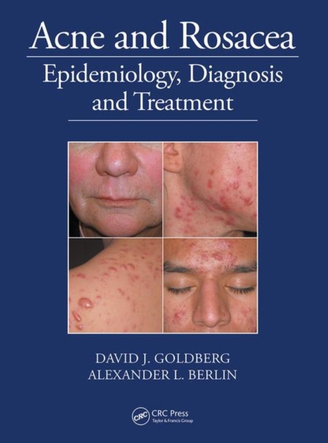 Acne and Rosacea : Epidemiology, Diagnosis and Treatment, Paperback / softback Book