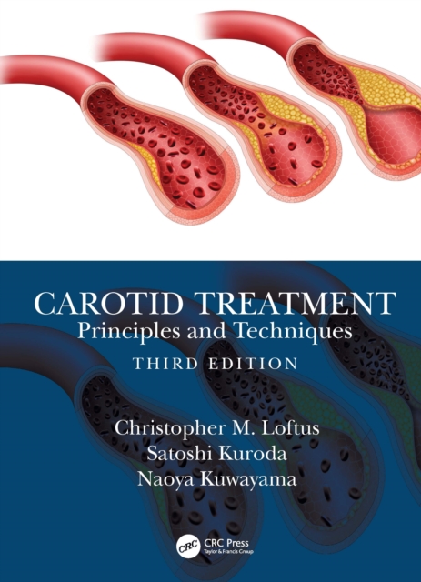 Carotid Treatment: Principles and Techniques, Hardback Book