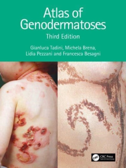 Atlas of Genodermatoses, Hardback Book
