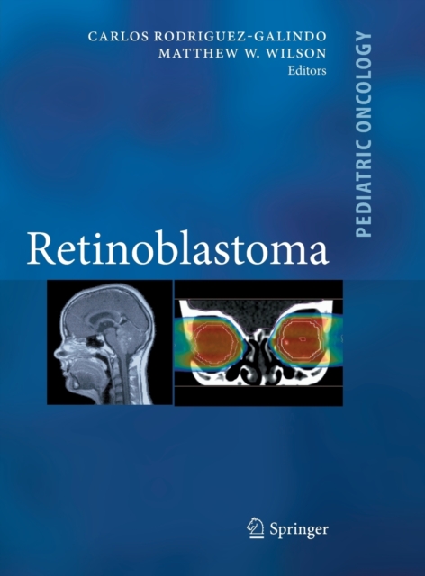 Retinoblastoma, Hardback Book