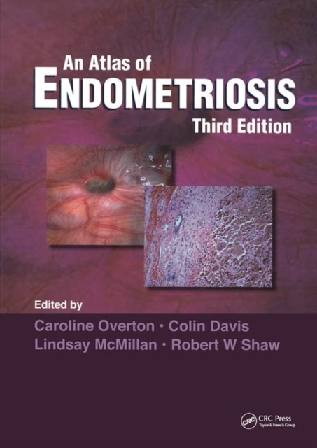 Atlas of Endometriosis, Hardback Book