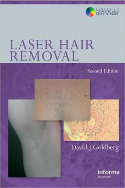 Laser Hair Removal, Hardback Book