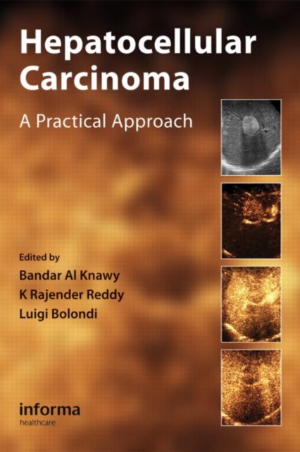 Hepatocellular Carcinoma : A Practical Approach, Hardback Book