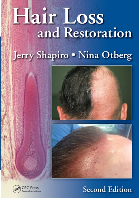 Hair Loss and Restoration, EPUB eBook