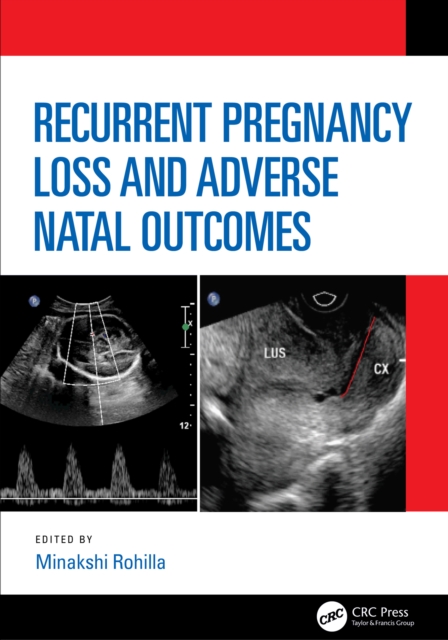 Recurrent Pregnancy Loss and Adverse Natal Outcomes, PDF eBook