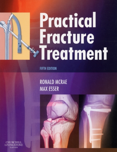 Practical Fracture Treatment, Paperback / softback Book