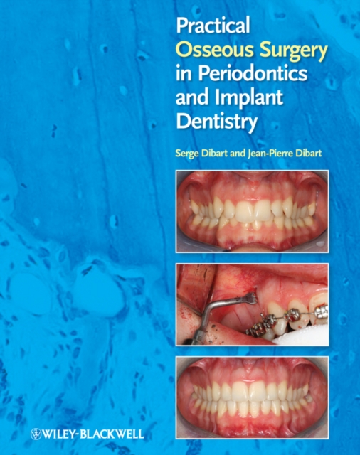 Practical Osseous Surgery in Periodontics and Implant Dentistry, PDF eBook