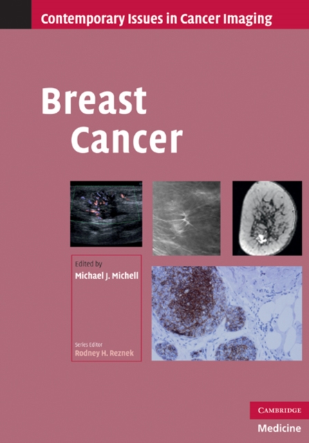 Breast Cancer, EPUB eBook