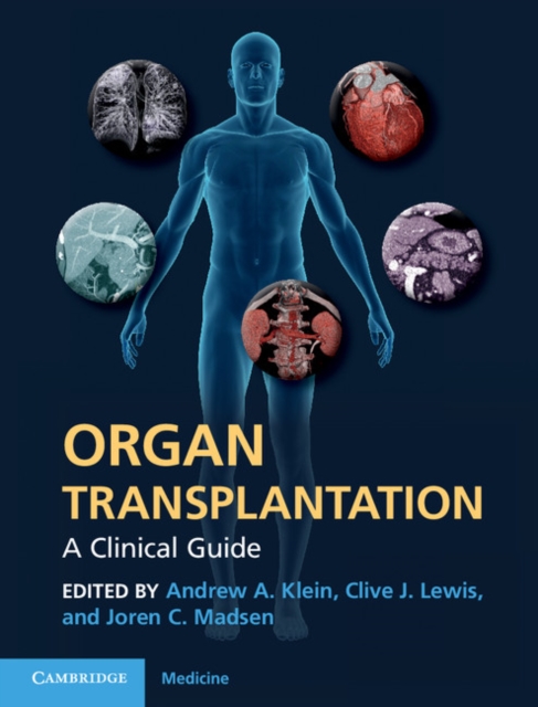 Organ Transplantation : A Clinical Guide, Hardback Book