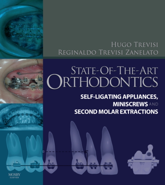 State-of-the-Art Orthodontics : Self-Ligating Appliances, Miniscrews and Second Molars Extraction, Hardback Book