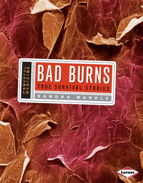 Bad Burns : True Survival Stories, PDF eBook