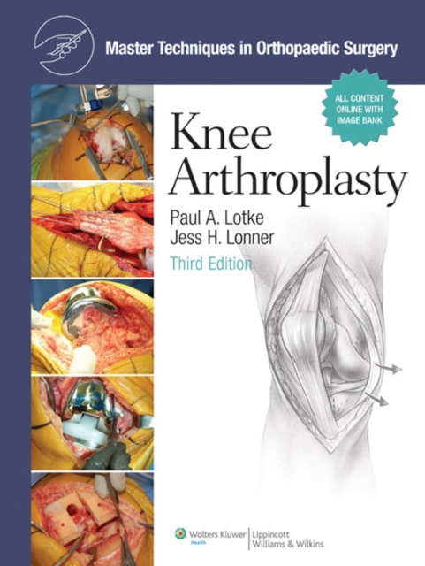Master Techniques in Orthopaedic Surgery: Knee Arthroplasty, Hardback Book