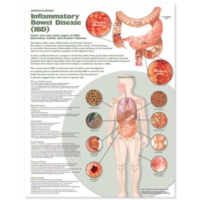 Understanding Inflammatory Bowel Disease (IBD) Anatomical Chart, Wallchart Book