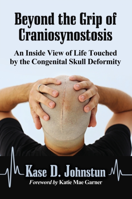 Beyond the Grip of Craniosynostosis : An Inside View of Life Touched by the Congenital Skull Deformity, Paperback / softback Book