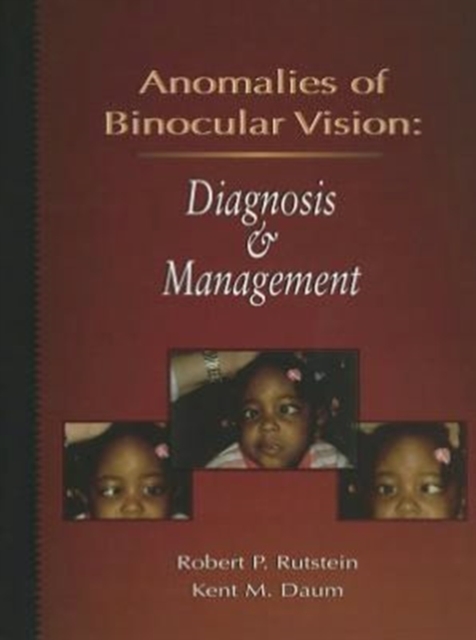 Anomalies Of Binocular Vision : Diagnosis And Management, Hardback Book