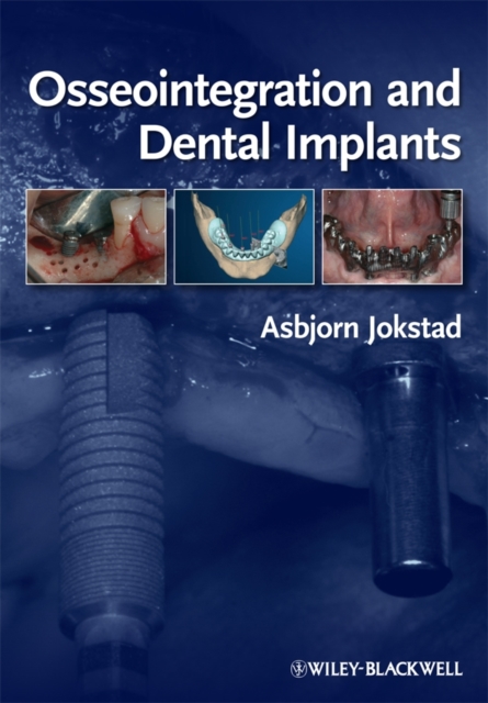 Osseointegration and Dental Implants, Hardback Book