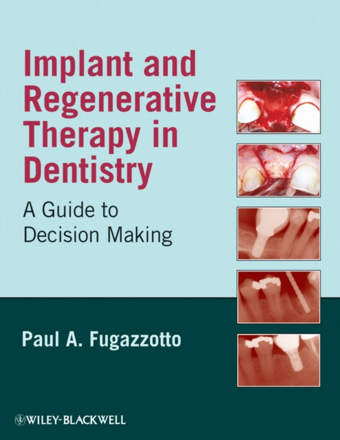 Implant and Regenerative Therapy in Dentistry : A Guide to Decision Making, PDF eBook