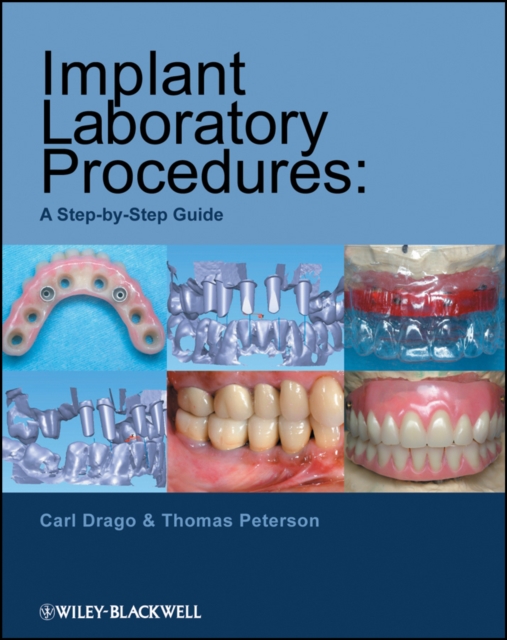 Implant Laboratory Procedures : A Step-by-Step Guide, PDF eBook