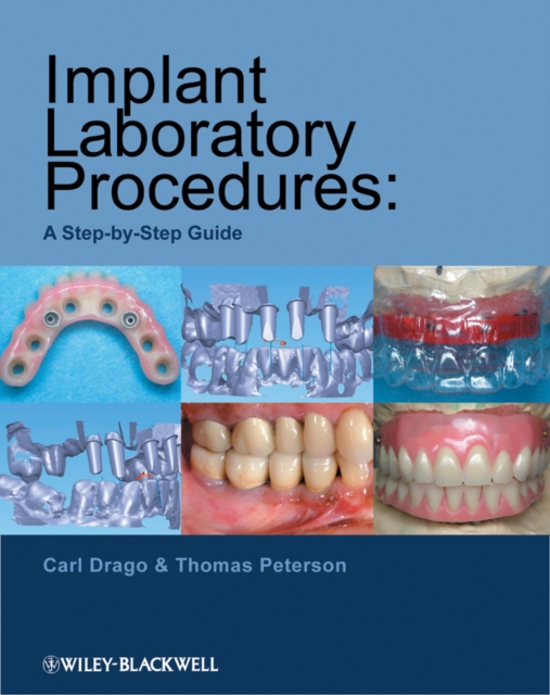 Implant Laboratory Procedures : A Step-by-Step Guide, Other book format Book