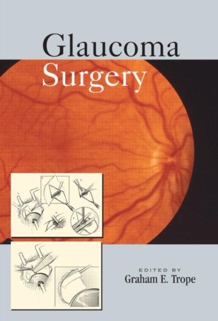Glaucoma Surgery, Hardback Book