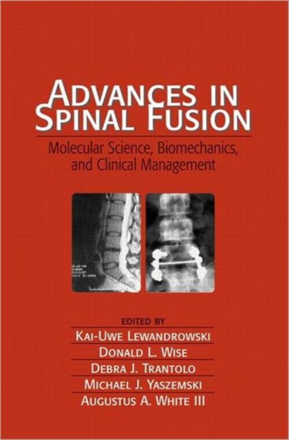 Advances in Spinal Fusion : Molecular Science, BioMechanics, and Clinical Management, Hardback Book